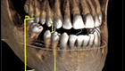 歯科用CT